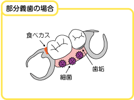 イラスト:総義歯の場合と部分義歯の場合